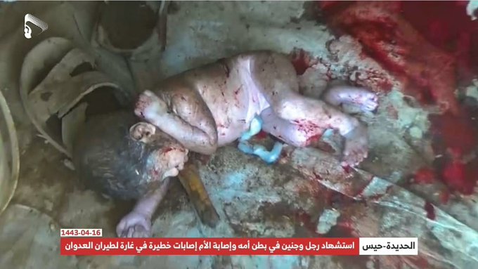 اغرب حالة ولادة طفل في العالم يمنية (صور)